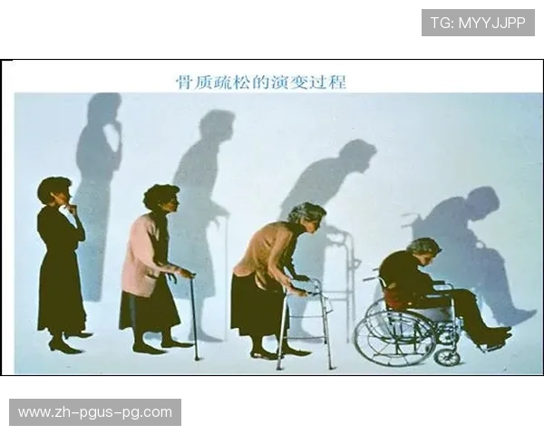 骨密度训练与预防骨质疏松的重要性